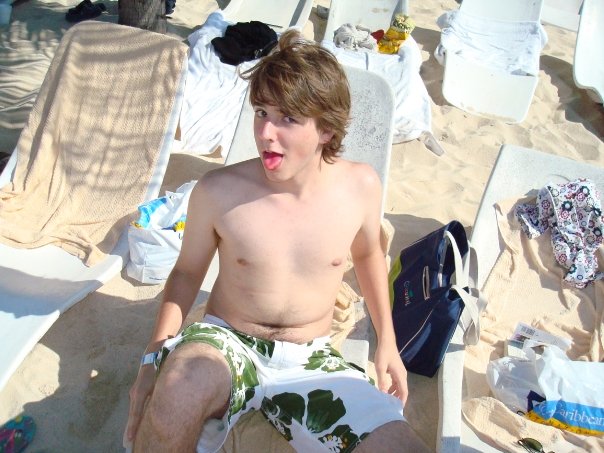 Ben displays the consequences of failing to to apply sun block to the most active part of his face.